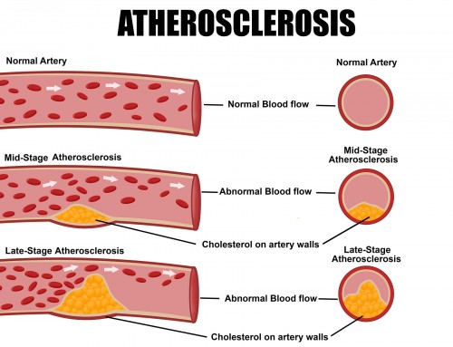 What is Atherosclerosis and its associated risk factors?